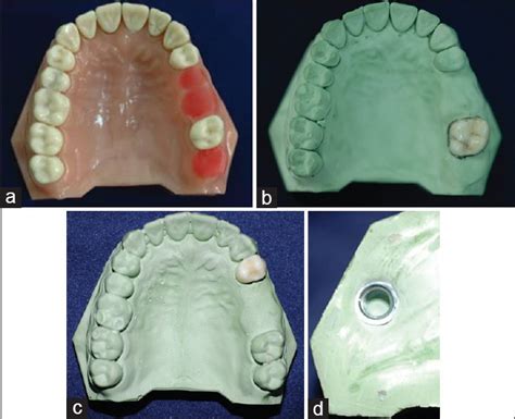 Effect of clasp type and pullout location on clasp retention in .